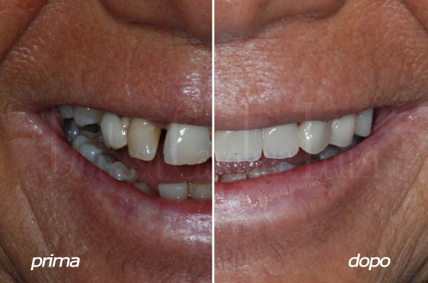 arcata completa superiore sorriso