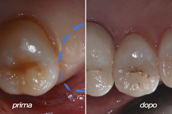 caso 2 dente singolo