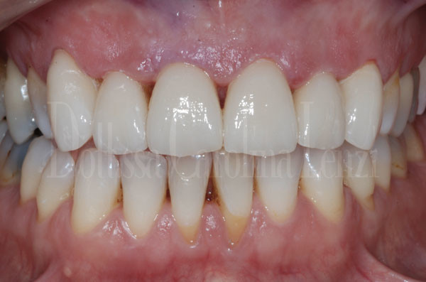 faccette dentali caso 1 dopo dettaglio denti