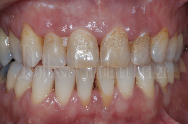faccette dentali caso 1 prima dettaglio denti