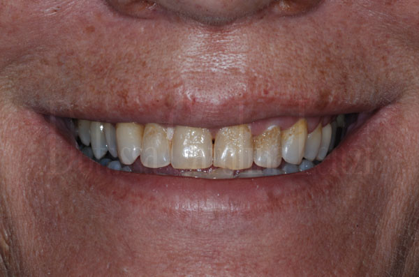 faccette dentali caso 1 prima 
