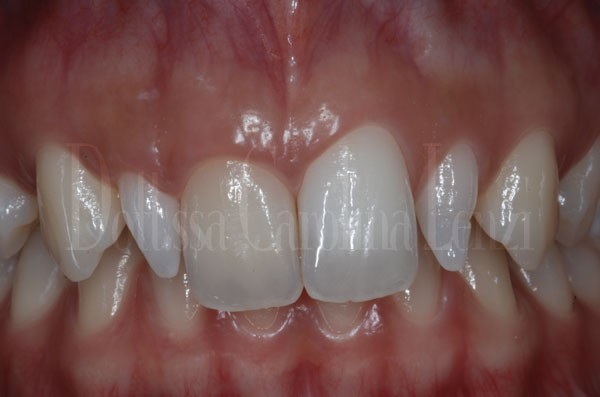 Faccette dentali caso 2 prima 