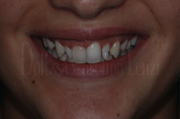 Caso due faccette dentali PRIMA