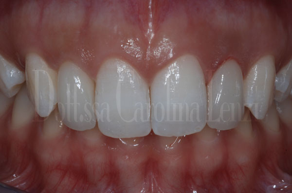 smile-design-denti-dopo