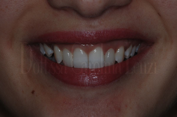 smile-design-sorriso-dopo