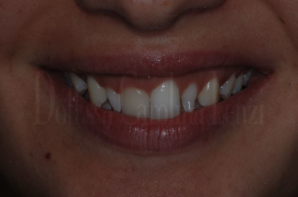 smile-design-sorriso-prima