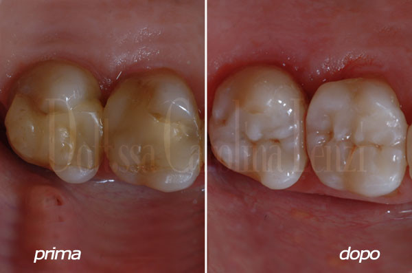 intarsio al molare prima e dopo