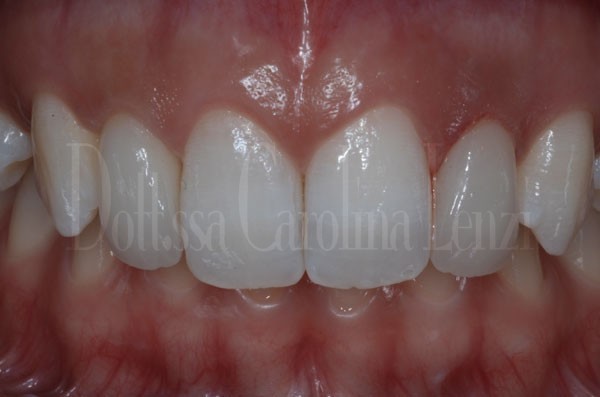 Faccette dentali caso 2 dopo dettaglio denti