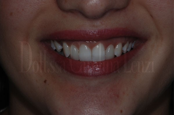 Faccette dentali caso 2 dopo sorriso